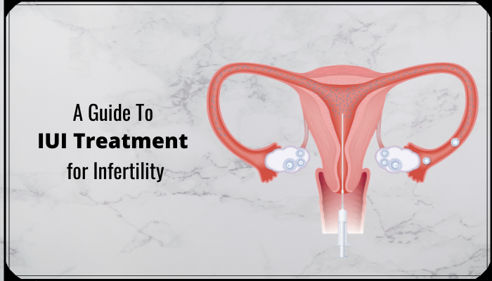 A Guide To IUI Treatment for Infertility